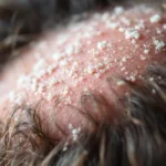 erfahren sie, was passiert, wenn man 30 tage lang einen juckenden kopf ignoriert. eine spannende persönliche geschichte und wichtige erkenntnisse zur kopfhautgesundheit.